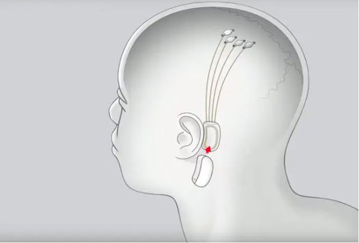 মানুষের মস্তিষ্কে সফলভাবে মাইক্রোচিপ স্থাপনের দাবি করল ইলন মাস্কের প্রতিষ্ঠান
